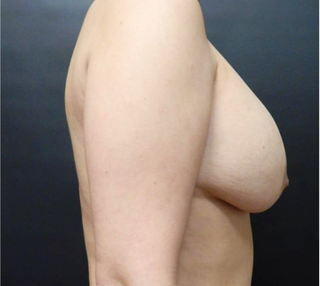 Breast Augmentation Patient Before - 2